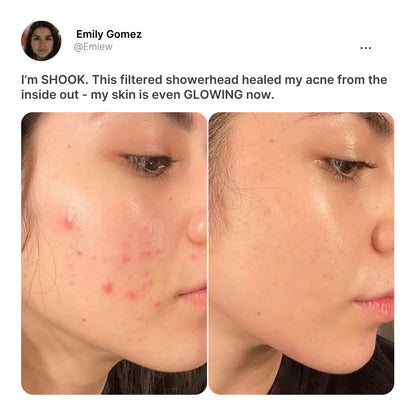 The Derma Showerhead